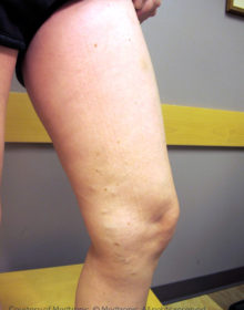Vein-Treatment-Patient04-After