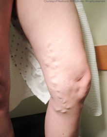 Vein-Treatment-Patient04-Before