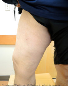 Vein-Treatment-Patient06-After