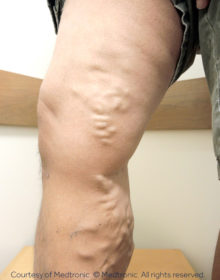 Vein-Treatment-Patient06-Before