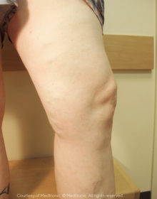 Vein-Treatment-Patient13-After
