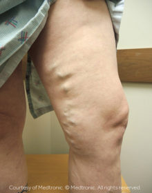 Vein-Treatment-Patient13-Before