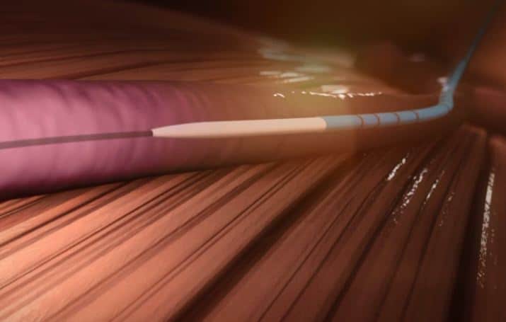 VenaSeal | Precision VIR Dallas Frisco Plano TX