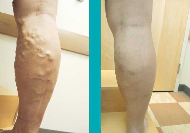 VenaSeal Treatment for Varicose Veins: Patient Before After Photo