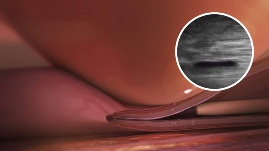 VenaSeal Varicose Vein Treatment-Internal Compression with Ultrasound