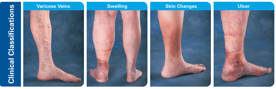 Venous-Disease-Symptoms-Progression