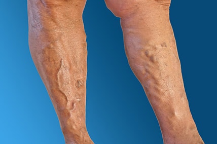 Venous Disorders Varicose Veins DVT