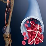 Venous-Treatments-THROMBOLYSIS