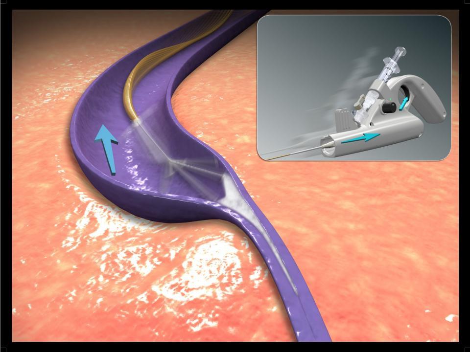 ClariVein Treatment (Mechanochemical)