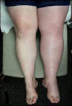 DVT: may cause the one leg to swell, discolor, and cramp like a “charlie horse.”