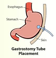 Aspirations & Drainage Management | Gastrostomy Tube Placement | G tube
