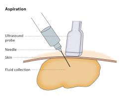 Aspirations- Percutaneous