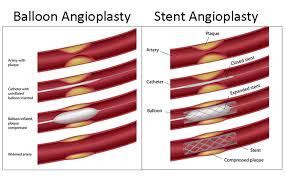 PAD Treatment Angioplasty