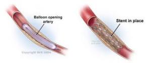 PAD Treatment Stent Graphs