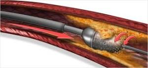 PAD Treatment Atherectomy