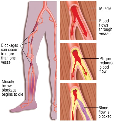 peripheral arterial disease (PAD)