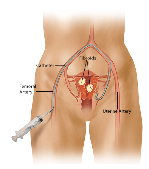 Uterine Fibroid Embolization - UFE overview