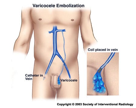 Varicocele Treatments- Embolization