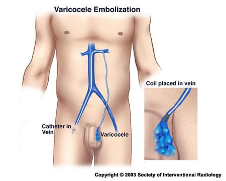 Varicocele Embolization