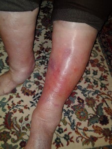 What Is Venous Stasis Dermatitis?