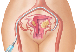 Pelvic Congestion - treatment